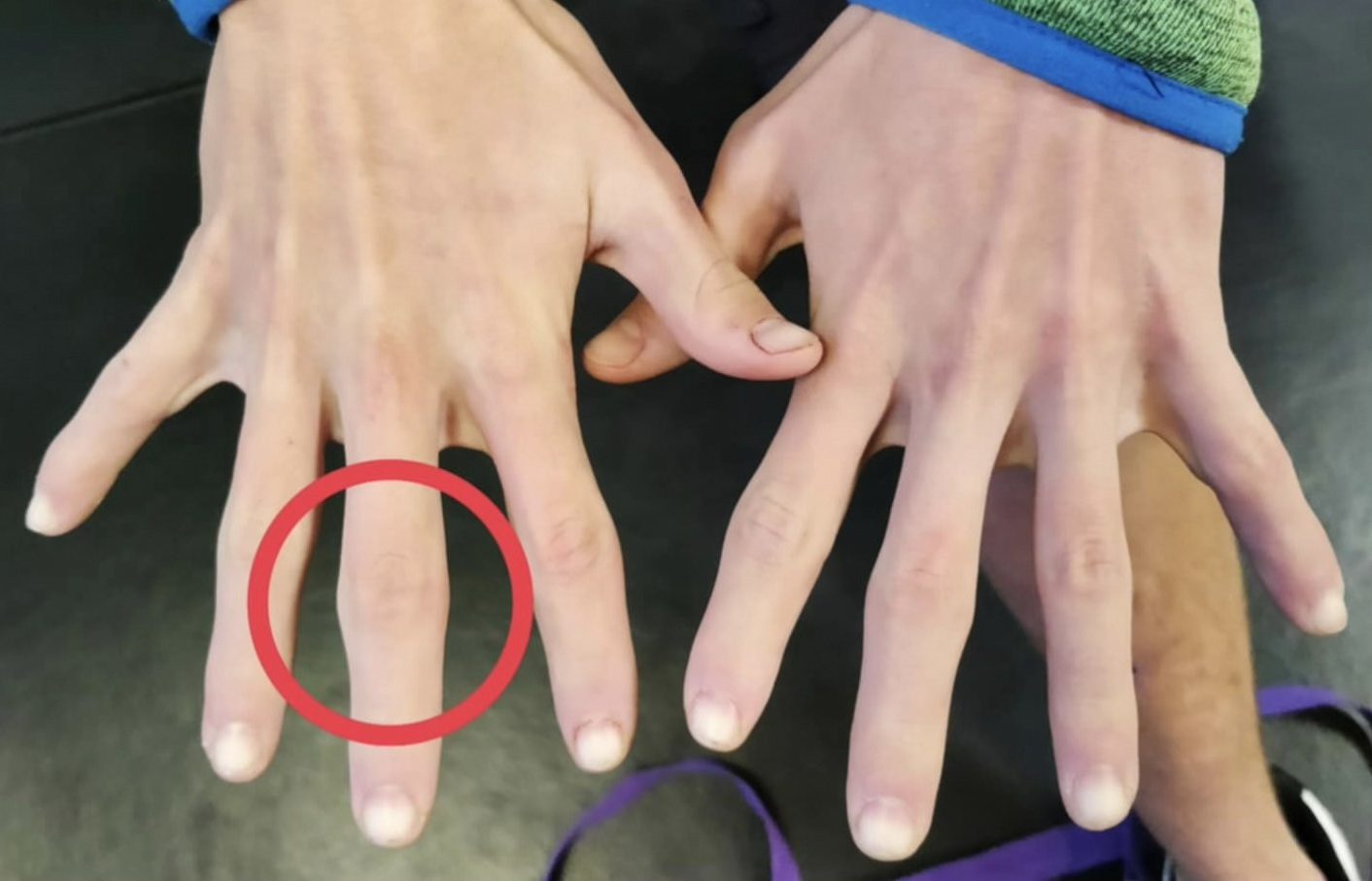 Blessures aux doigts chez les adolescents : Lésions épiphysaires